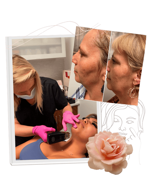 3 Session Package of Morpheus8 Black Friday Special